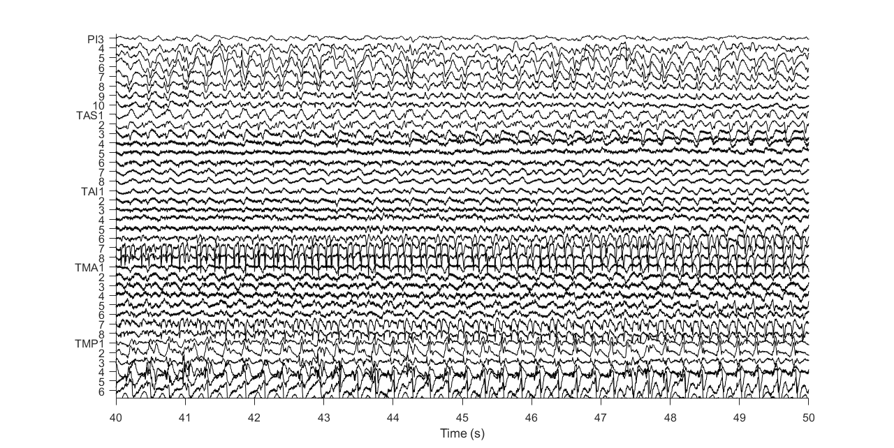 Patient's Electrodes